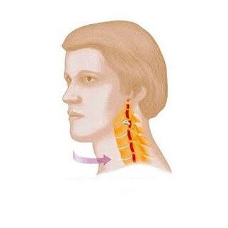 síndrome vertebral con osteocondrosis cervical