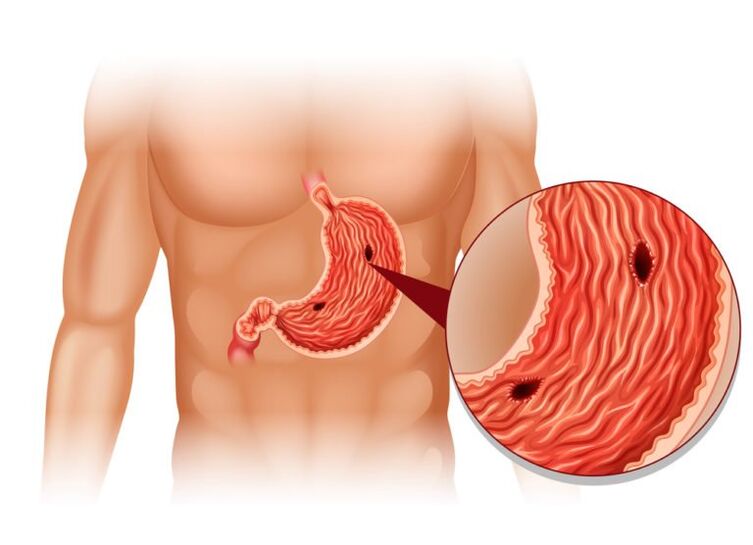 úlcera como causa del dolor debajo del omóplato izquierdo detrás