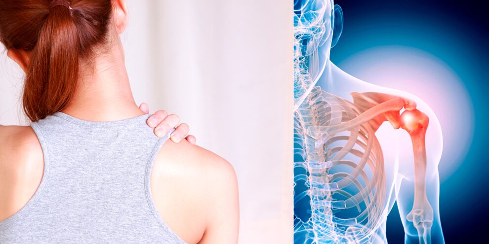 El desarrollo de la artrosis del hombro conduce gradualmente a un dolor constante. 