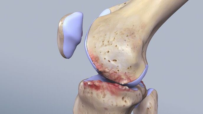 La estructura de la articulación de la rodilla afectada por la patología. 