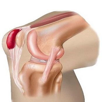 Una de las causas del dolor en las articulaciones de la rodilla es la bursitis. 
