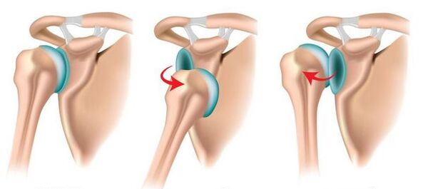 Luxación anterior y posterior de la articulación del hombro, provocando el desarrollo de artrosis. 