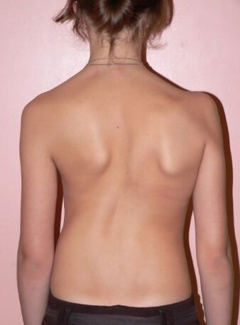 Escoliosis 2 grados