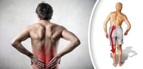 Síndrome de dolor con osteocondosis lumbar irradia en las piernas