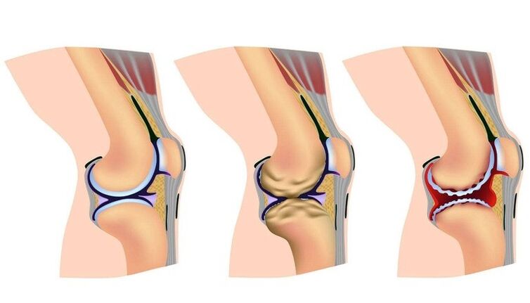 Fase de deformación en la articulación de la rodilla para la artrosis