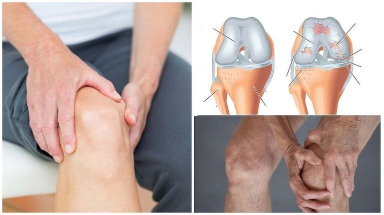 Síntoma del dolor de rodilla de la artrosis de la articulación de la rodilla