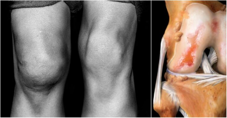 artrosis de la articulación de la rodilla y docena
