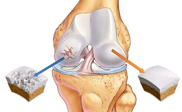 cartílago normal y golpeado por la osteoartritis