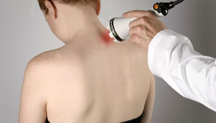 Terapia con láser para la osteocondrosis cervical.