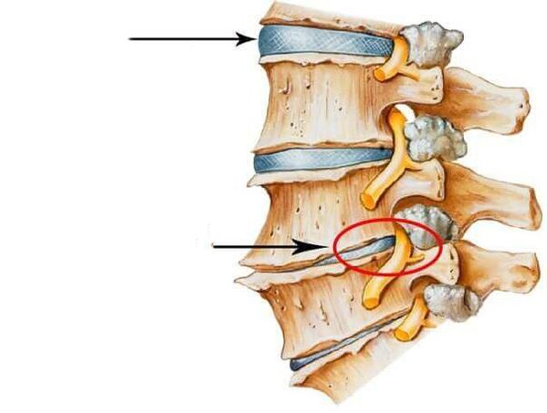 disco normal y dañado en la columna vertebral