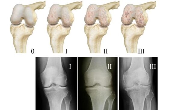 Métodos para diagnosticar la osteoartritis de rodilla.