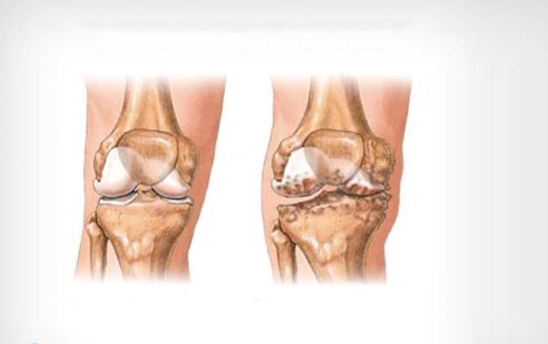 artrosis de la articulación de la rodilla