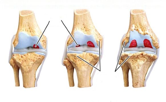 etapas de la osteoartritis de rodilla
